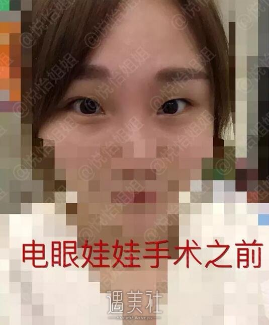 武警总医院王征双眼皮案例：王医生的技术果然很精湛呐~ width=