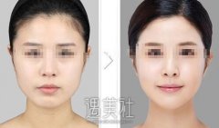 上海做宽下颌角整形一般多少钱?和小编一起来揭晓～ width=