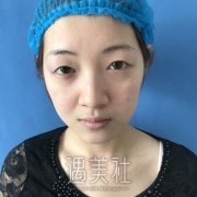 刘冬青医生割双眼皮怎么样|刘冬青双眼皮案例震撼分享～ width=