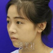 侯亚杰双眼皮全切恢复过程记录，还有很多果照片喃～ width=
