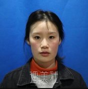 首尔丽格洪性范V-line型颜面轮廓整形手术案例，果很好! width=
