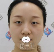 沈阳百嘉丽医院侯亚杰做双眼皮怎么样？想看看他的案例！ width=