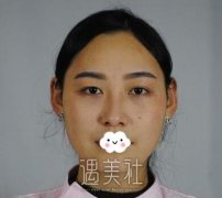 上海鹏爱医疗美容医院割双眼皮怎么样？案例果分享～ width=