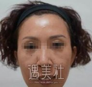 鼻唇沟微整形果好不好喃？有案例分享一下吗？ width=