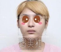 何晋龙削骨手术前后对比图片|何晋龙削骨手术案例~ width=
