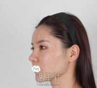 首尔丽格洪性范颧骨降低术案例：终于丢掉“点酸刻薄”标签～ width=