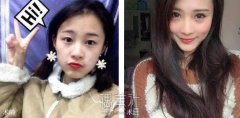 埋线双眼皮果图片分享：埋线双眼皮果还是挺好的～ width=