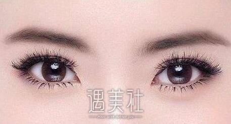 北京埋线双眼皮修复