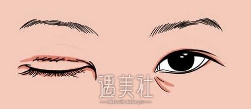 北京埋线双眼皮修复