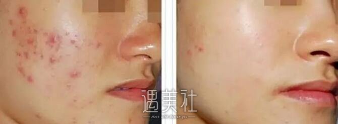 果酸换肤果怎么样