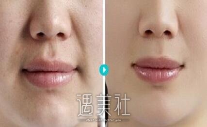 上海,鼻唇沟微整形