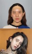 找广州曙光王旭明医生做了隆鼻，整张脸都变立体了呢! width=
