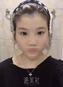 侯亚杰做双眼皮怎么样?有他近期的双眼皮案例看看吗? width=