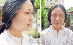 首尔丽格洪性范长曲线下颌角整形案例：恋上现在的我! width=