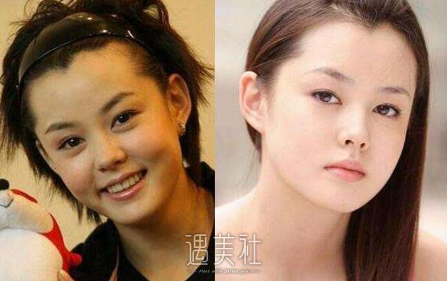 刘一含整容前后照片大肆流出，吃瓜群众表示这个八卦好～