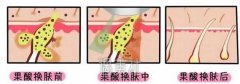 果酸换肤的果能维持多久呢|果酸换肤的果好吗? width=