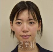 女孩天生无下巴很苦恼，垫假体后有了丰满的下巴呢~ width=