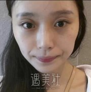 武汉伽美整形医院做了面部填充，整张脸都饱满了喃~ width=