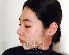 广州曙光万友望给我做了脂肪填充，后悔没有早点来做呢！ width=