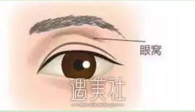 玻尿酸,眼窝填充