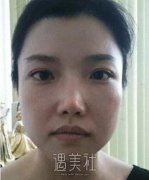 九院曹谊林下颌角磨骨案例展示：脸型是如此重要! width=