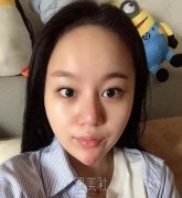 九院王炜隆鼻真实案例分享~前后变化确实很大! width=