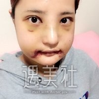 九院韦敏颧骨下垂矫正案例，终于能回归状态了!