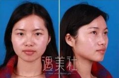 九院张路双眼皮案例展示，看看拥有双眼皮前后的差距~ width=