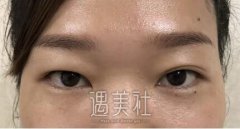 祝联双眼皮真实案例分享，看看小眼睛是如何逆袭的! width=