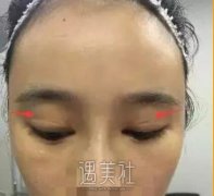 祝联双眼皮修复案例展示，回归过去不是梦! width=
