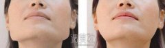 上海磨腮削骨手术大约要多少钱?受哪些因素的影响呢? width=