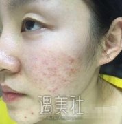 成都铜雀台做了像素激光除痘印，皮肤变得炒鸡光滑呢! width=