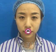 上海华美开双眼皮案例分享：有颗爱美的心就能变美！ width=