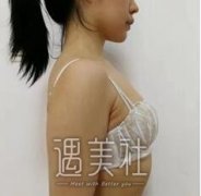 广州曙光江华做隆胸怎么样？有江华医生的隆胸案例吗？ width=