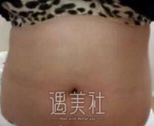 青岛伊美尔做了吸脂后，我的身材变得更加协调了哦 width=