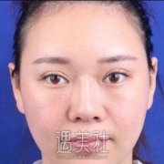 陈付国鼻修复案例：隆鼻失败还有救 width=