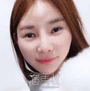 上海九院韦敏磨颧骨案例：这下闺蜜不会再说我面相不好了~ width=