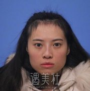 上海九院韦敏颧骨内推案例：巴掌脸亦我所欲也 width=