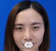 朴相根双眼皮案例硬核分享：朴医生做双眼皮技术果然牛啤~ width=