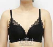 广州曙光程鹏脂肪填充案例：脂肪长在了该长的地方真棒！ width=