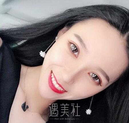 自体脂肪填充法令纹