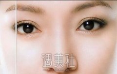 北京双眼皮修复多少钱？来看看是哪些因素影响了它的收费~ width=