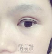 周一雄双眼皮修复案例：现在每天都美美哒 width=