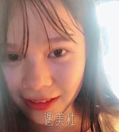 周一雄,双眼皮修复