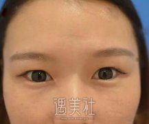 张余光双眼皮手术案例：原来自己可以变得这么美 width=