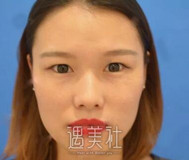 张余光,双眼皮