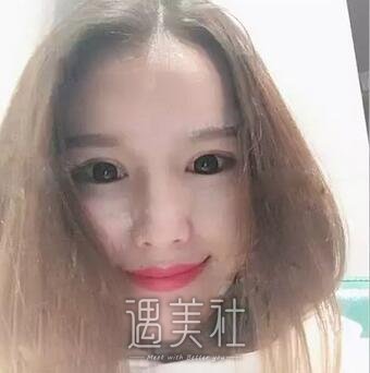 张余光,双眼皮