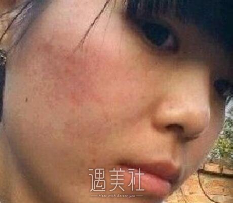 阎春林,祛痘