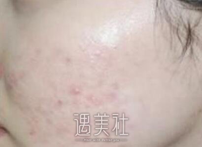阎春林,祛痘