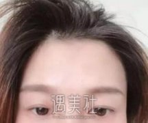 亓发芝割双眼皮案例：这是天上下凡的小仙女嘛 width=
